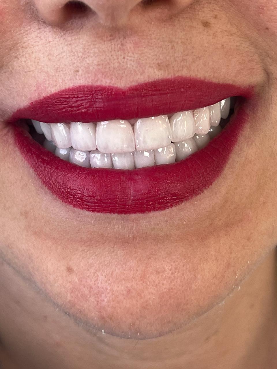 Dental Prosthetics